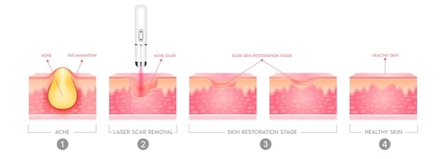 A diagram illustrating the process of microneedling on the skin. It shows the microneedling device creating micro-injuries, and then highlights the skin's response, including the production of collagen and elastin, leading to the remodeling of scar tissue. The diagram includes annotations explaining each stage of the process.