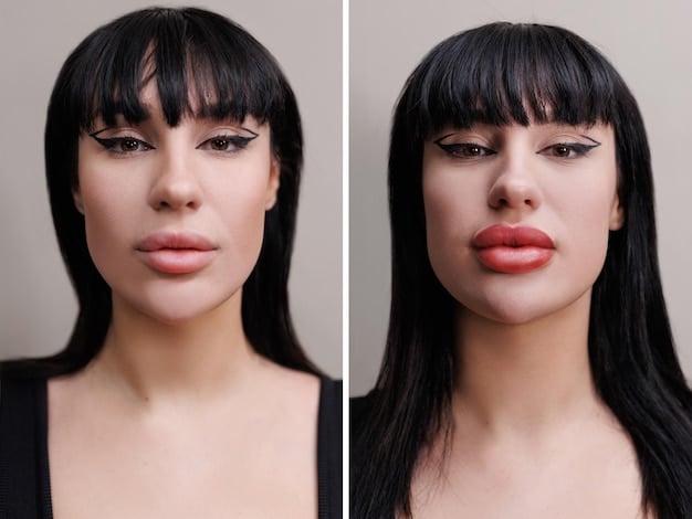 Before and after comparison of a patient undergoing a lip lift. The before image shows a longer distance between the nose and upper lip, while the after image shows a reduced distance and a more visible vermilion border.