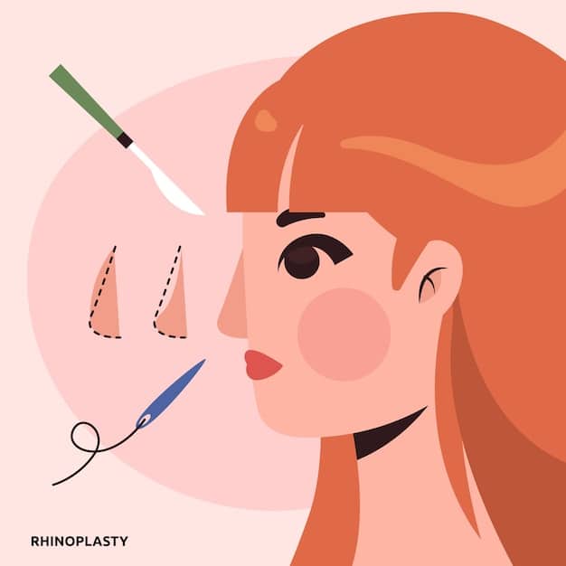 An illustration showing the precise measurements and skin excision areas during a bullhorn lip lift procedure. The illustration highlights how the technique effectively reduces the distance between the nose and the upper lip.