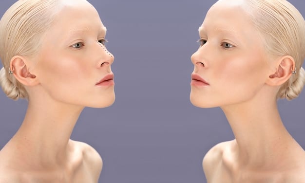 A digital rendering showing a before-and-after comparison of a patient undergoing non-surgical rhinoplasty with dermal fillers. The 'before' image shows a slightly uneven nasal bridge, and the 'after' image shows a visibly straightened and more symmetrical nasal contour achieved through the procedure.