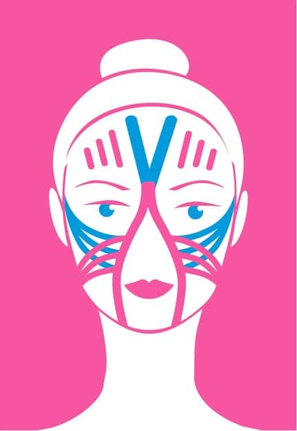 A surgical illustration depicting the incision lines and tissue repositioning involved in a traditional facelift. The illustration highlights the SMAS layer and how it is lifted and tightened.