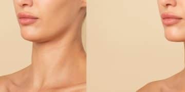 Neck Lift Surgery: Get a Smoother Neckline in Just 6 Months - Cover Image