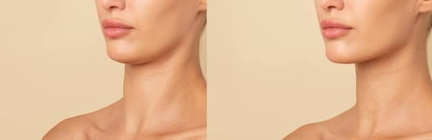 Neck Lift Surgery: Get a Smoother Neckline in Just 6 Months