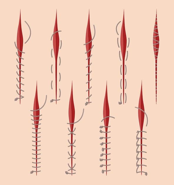 A detailed medical illustration showing the different incision patterns used in thigh lift surgery, including vertical thighplasty, inner thigh lift, and spiral thighplasty. The illustration highlights the areas of skin removal and the resulting scars.