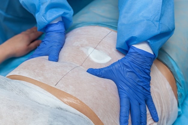 A close-up of a surgeon marking a patient's abdomen before a tummy tuck procedure. The markings indicate the planned incisions and areas where excess skin and fat will be removed.