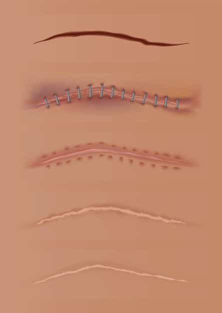 A graphic illustration depicting different types of scar revision techniques, including surgical excision, laser resurfacing, dermabrasion, and skin grafting. Each technique is shown applied to a different type of scar on various parts of the body.