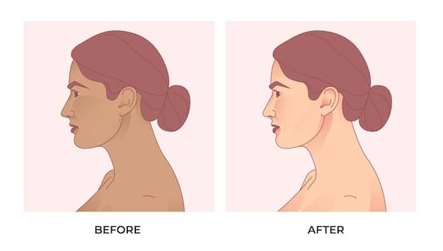 Side profile illustration showing the before and after of submental liposuction, highlighting the reduced fat and improved jawline definition.