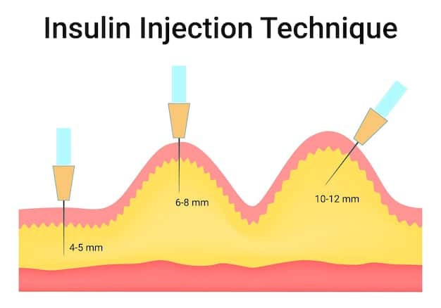 An illustrative diagram showing the process of facial fat grafting, from fat harvesting from the abdomen, through purification in a centrifuge, to precise re-injection into facial areas.