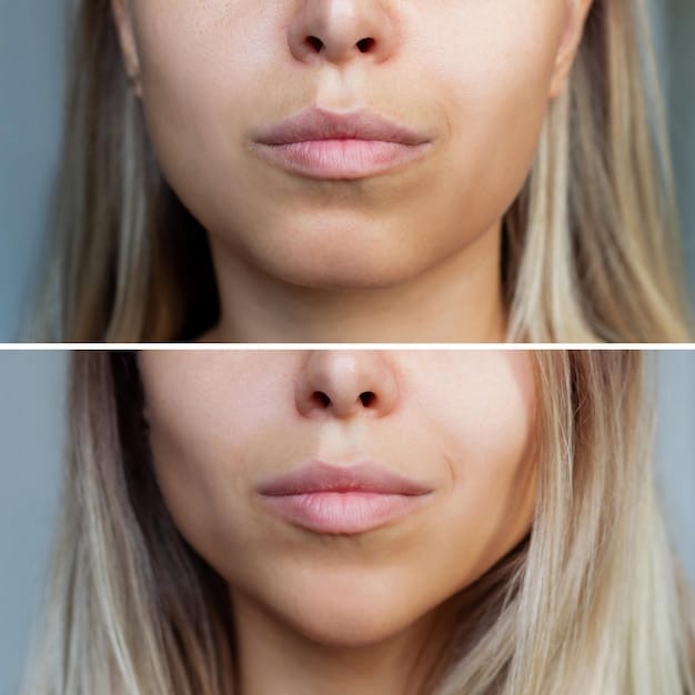 Lip Lift Techniques 2025: Shorten Nose-Lip Distance by 7mm