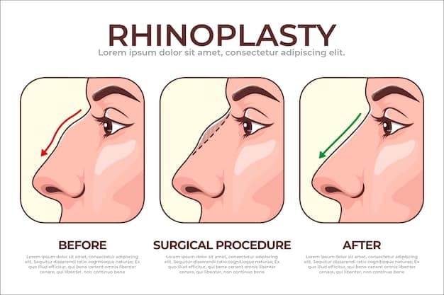 A detailed diagram showing the different injection points on a nose for non-surgical rhinoplasty, with labels indicating areas like 