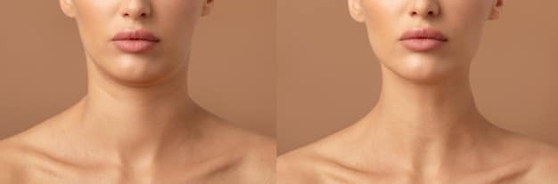 Close-up of a person's lower face showing before and after comparisons of a chin augmented with dermal fillers, highlighting subtle but effective contouring.