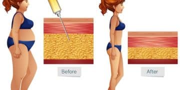 Liposuction Techniques: VASER, Power-Assisted, Tumescent Explained - Cover Image