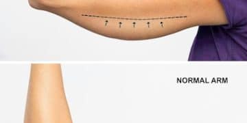 Scar Revision Surgery: Minimize Scars by Up to 50% - Cover Image