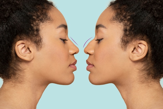 Side-by-side comparison of a woman's nose before and immediately after non-surgical rhinoplasty, showcasing subtle but noticeable improvement in straightness and definition.